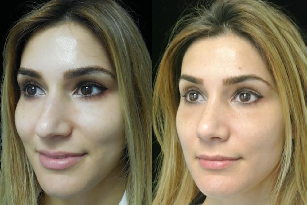 closed vs open rhinoplasty