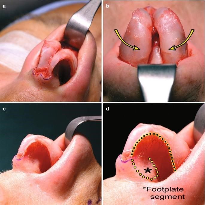 rhinoplasty nose surgery