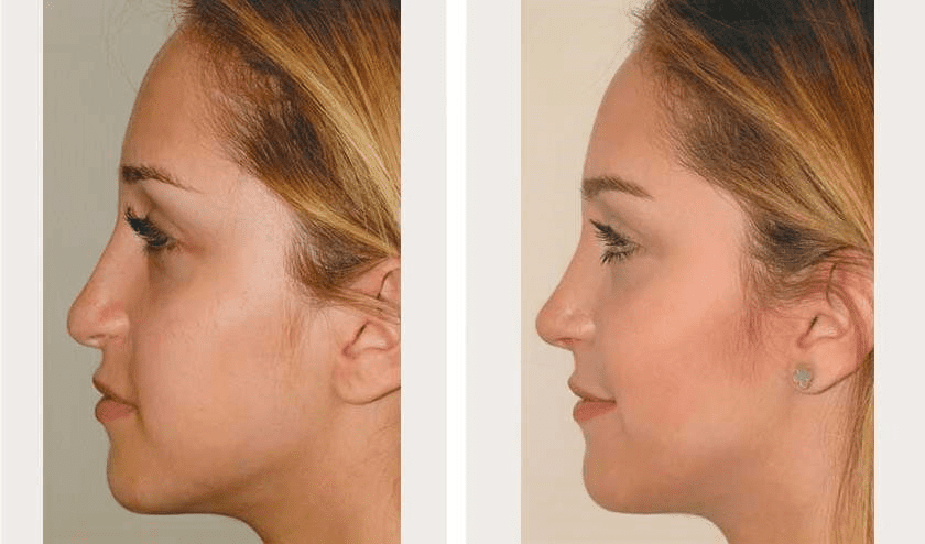 closed vs open rhinoplasty