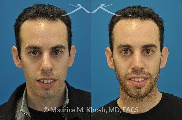 closed vs open rhinoplasty