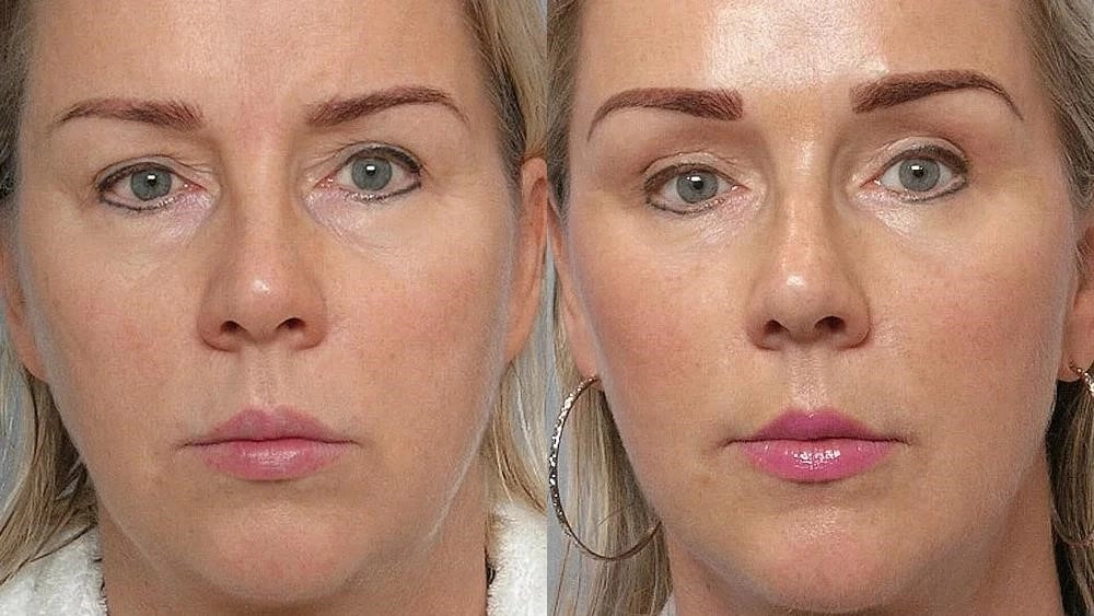 rhinoplasty nose surgery